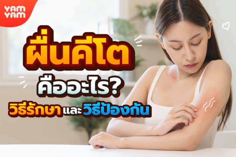 ผื่นคีโตคืออะไร